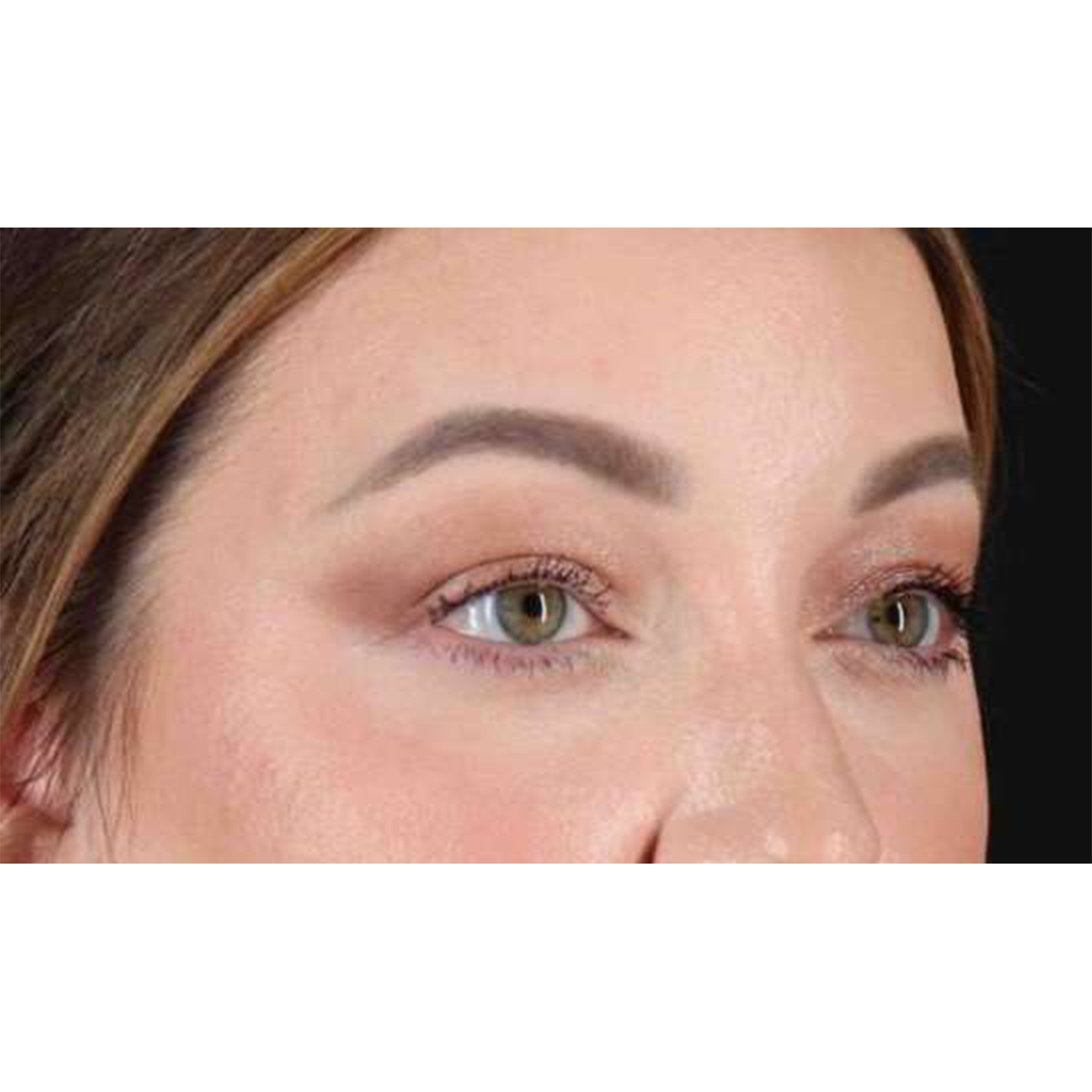 Eyelid Surgery Before & After Patient #2023