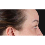 Eyelid Surgery Before & After Patient #2023