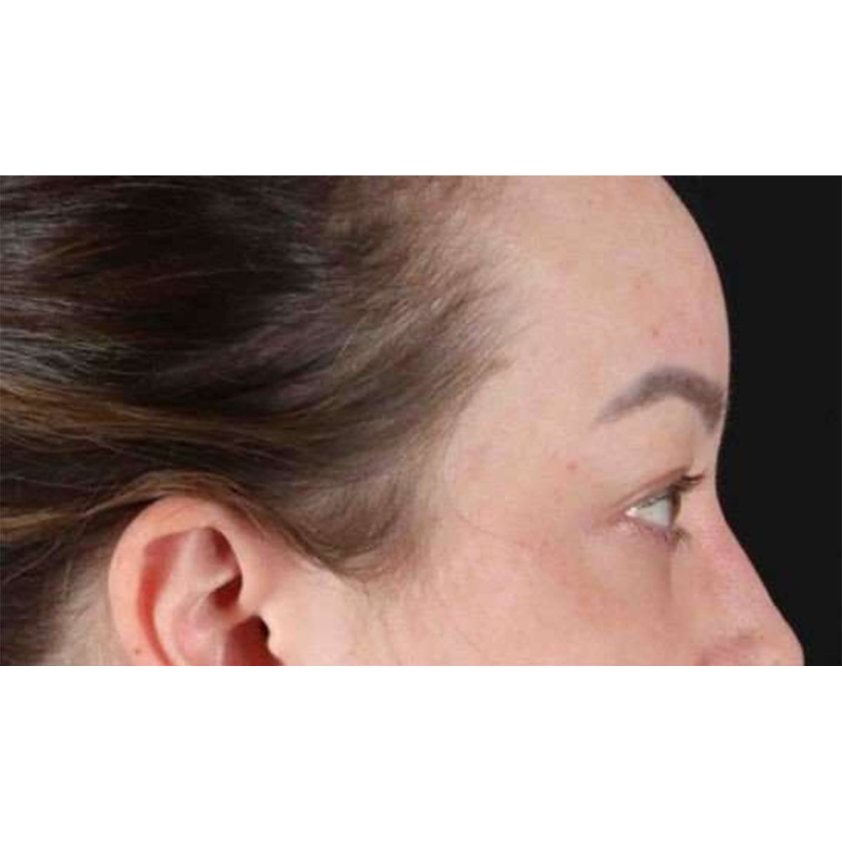 Eyelid Surgery Before & After Patient #2023