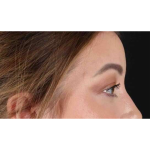 Eyelid Surgery Before & After Patient #2023