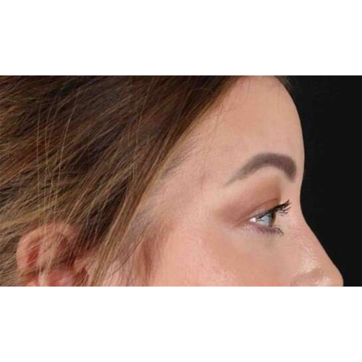 Eyelid Surgery Before & After Patient #2023