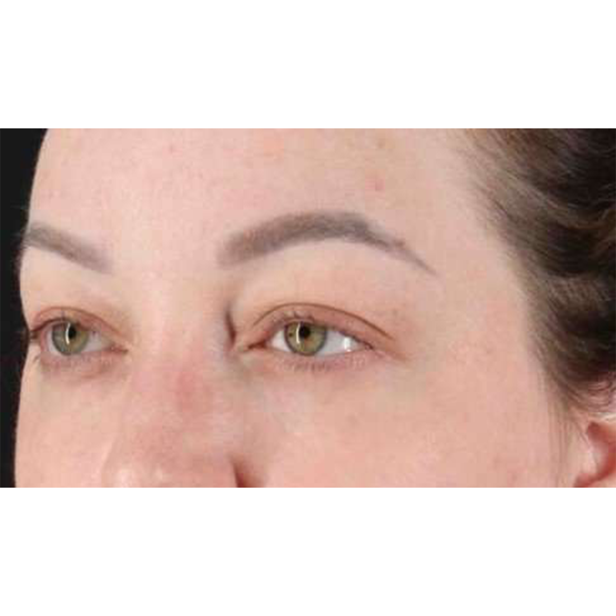 Eyelid Surgery Before & After Patient #2023