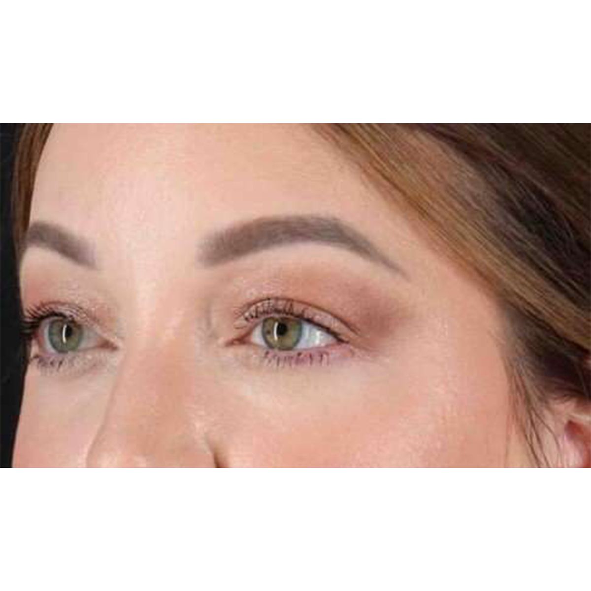 Eyelid Surgery Before & After Patient #2023