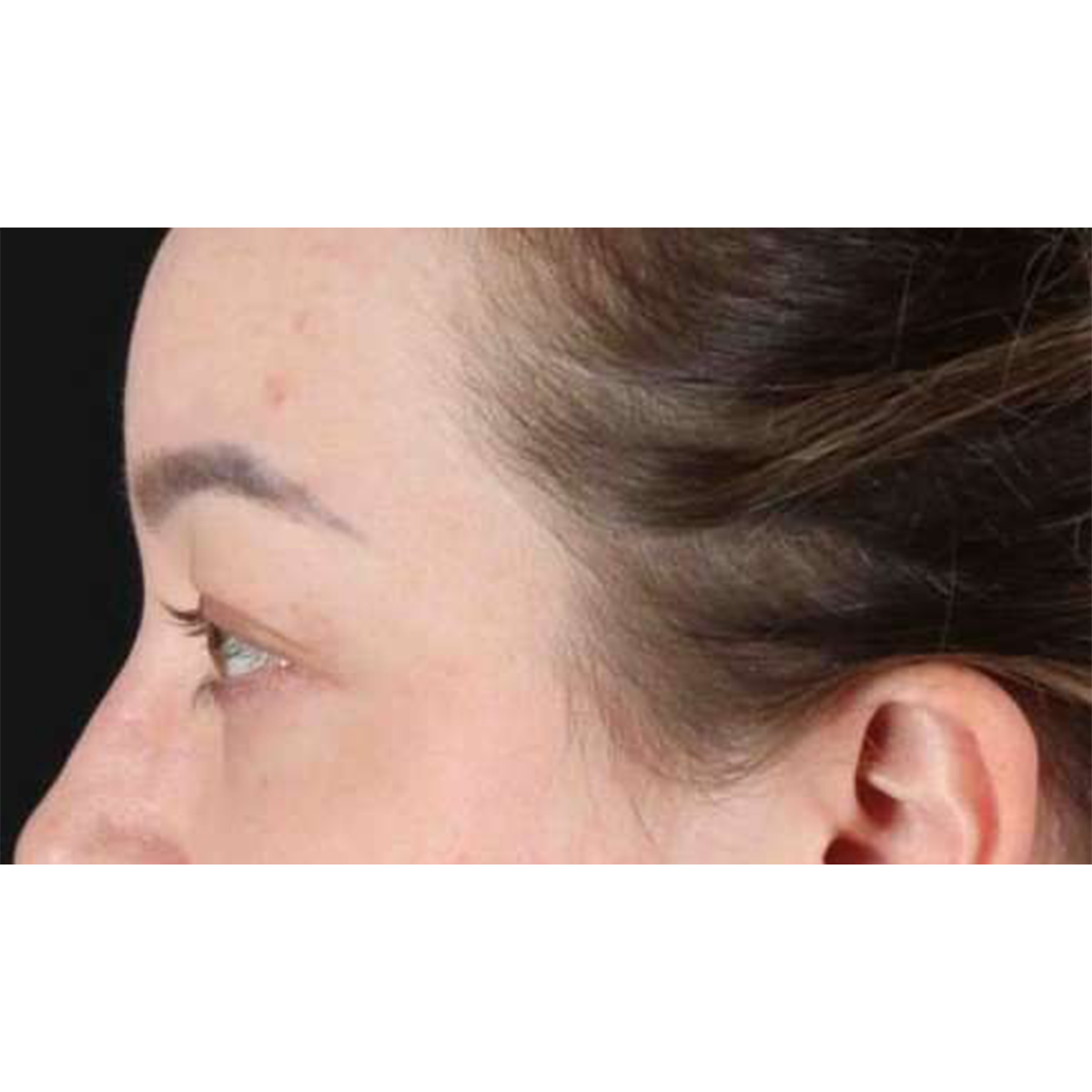 Eyelid Surgery Before & After Patient #2023