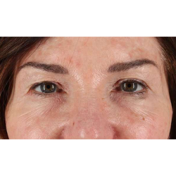 Eyelid Surgery Before & After Patient #2034