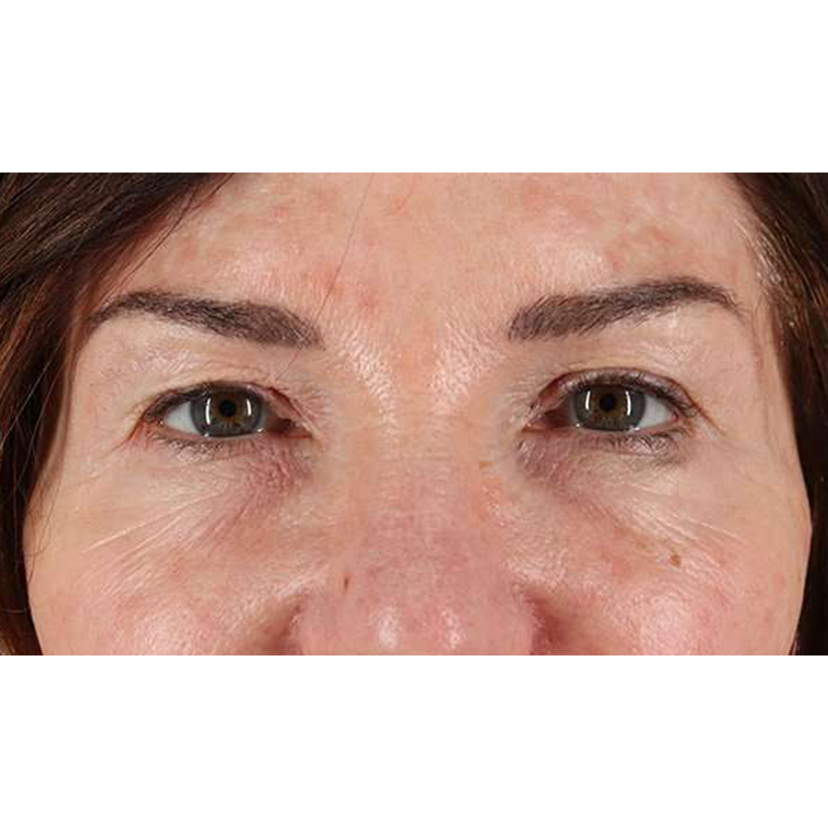 Eyelid Surgery Before & After Patient #2034