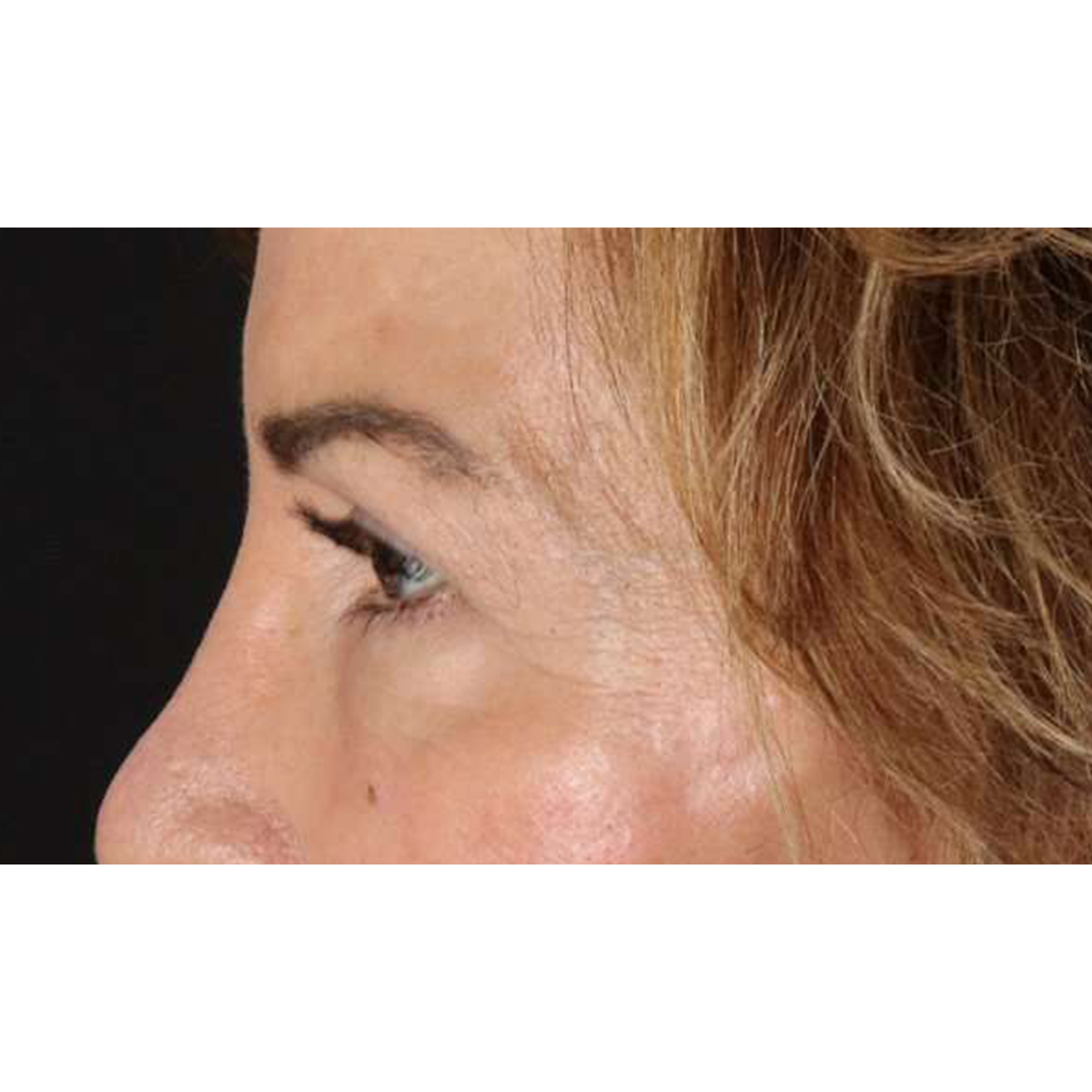 Eyelid Surgery Before & After Patient #2034
