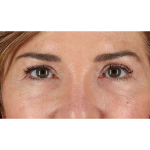 Eyelid Surgery Before & After Patient #2034