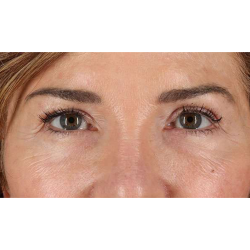Eyelid Surgery Before & After Patient #2034