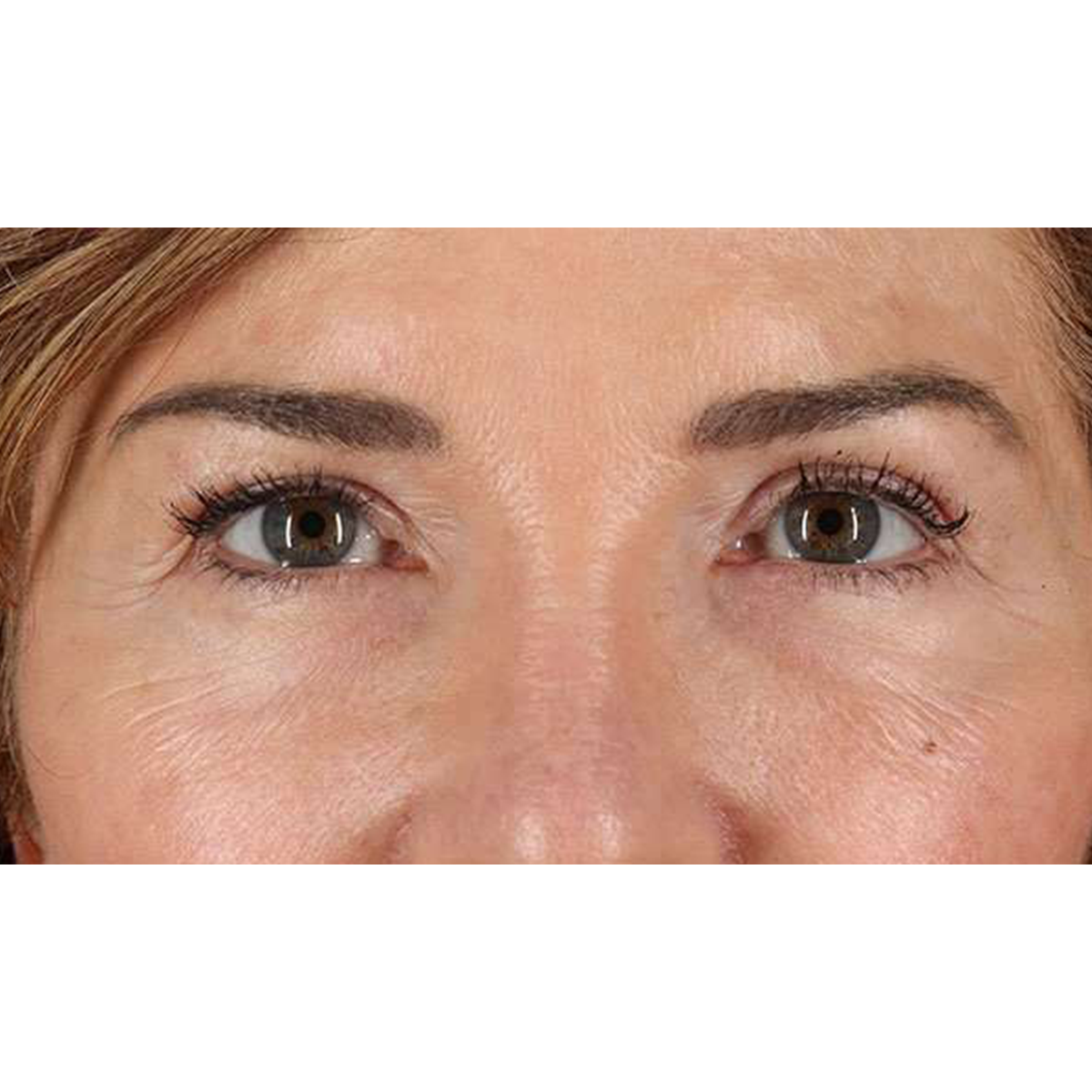 Eyelid Surgery Before & After Patient #2034