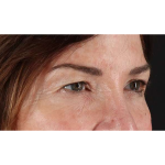 Eyelid Surgery Before & After Patient #2034