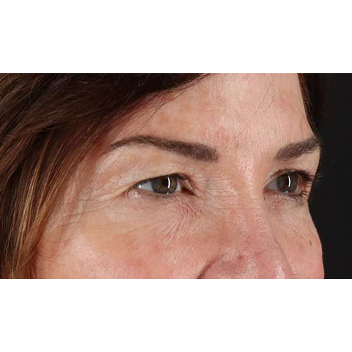 Eyelid Surgery Before & After Patient #2034