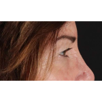 Eyelid Surgery Before & After Patient #2034