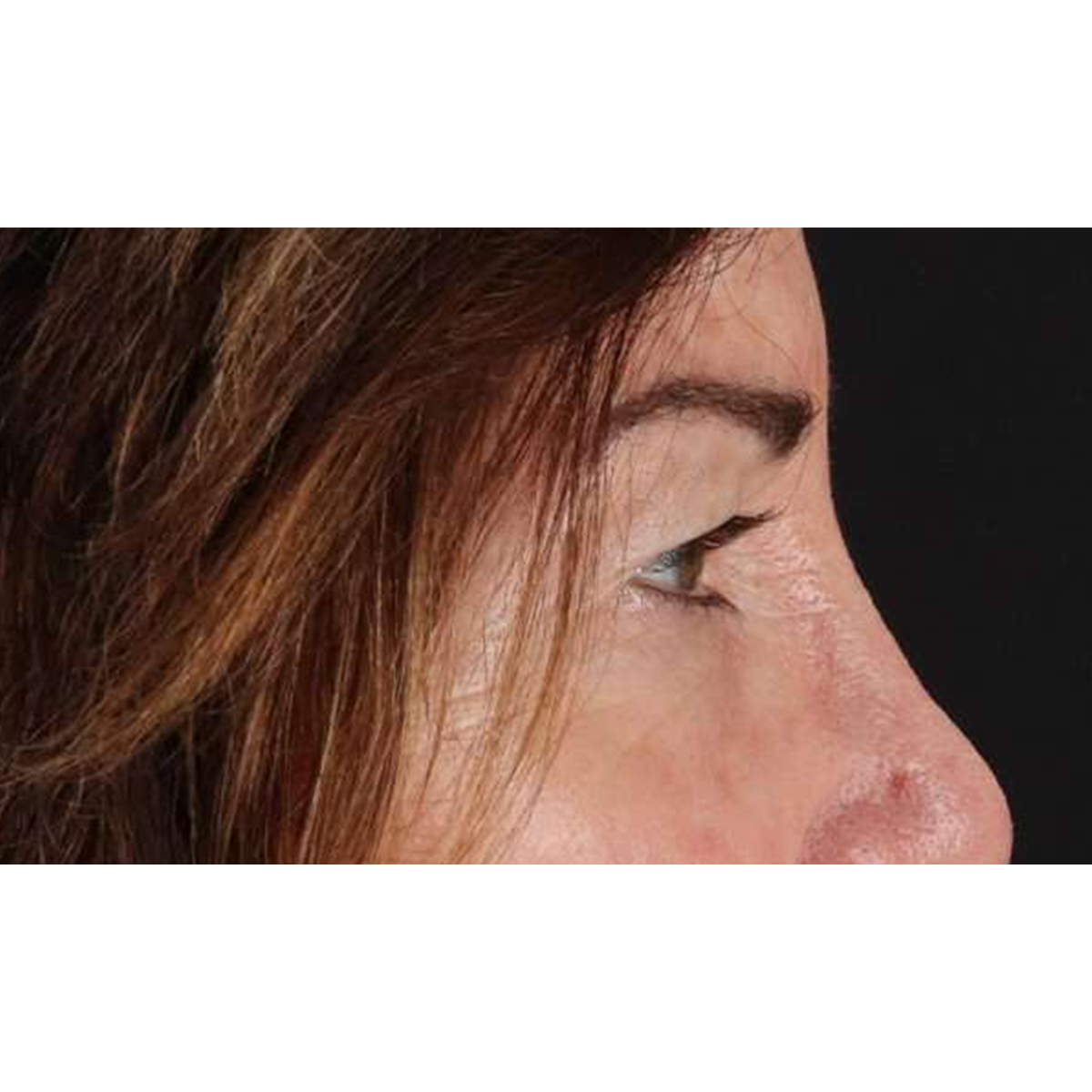 Eyelid Surgery Before & After Patient #2034