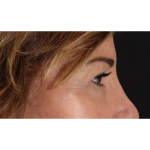 Eyelid Surgery Before & After Patient #2034