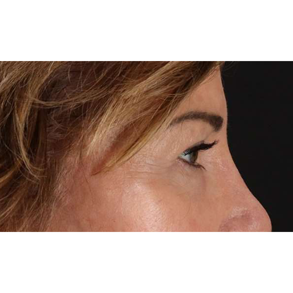 Eyelid Surgery Before & After Patient #2034