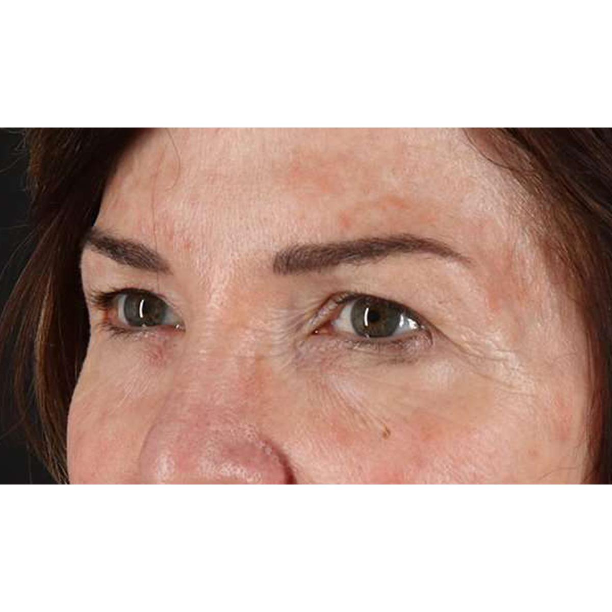 Eyelid Surgery Before & After Patient #2034