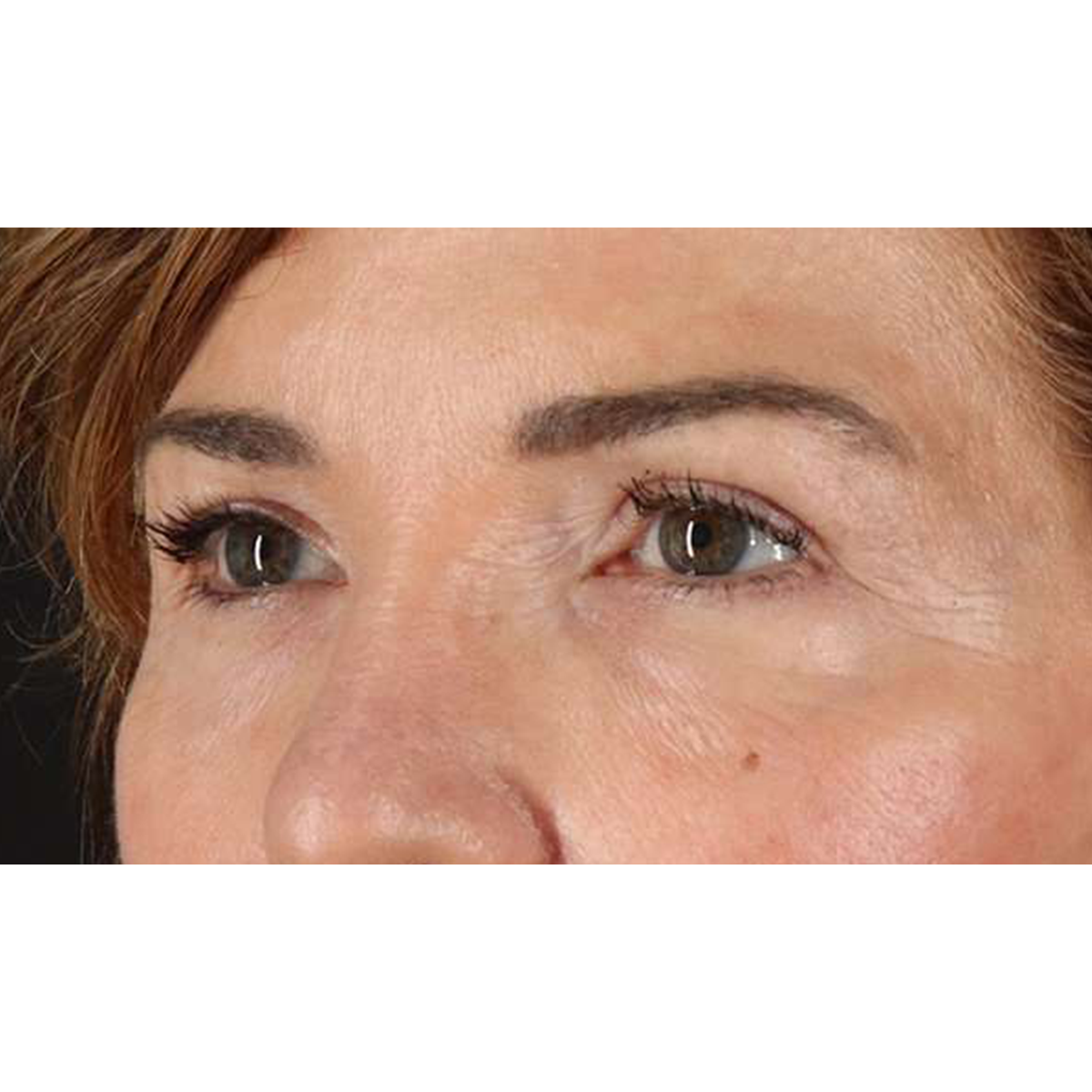 Eyelid Surgery Before & After Patient #2034
