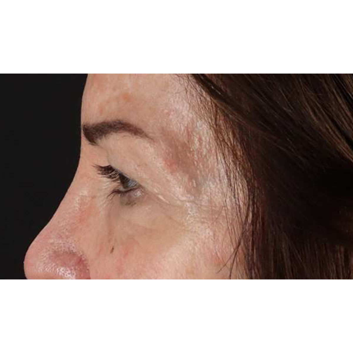 Eyelid Surgery Before & After Patient #2034