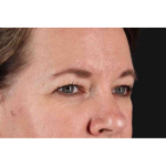 Brow Lift Before & After Patient #1566