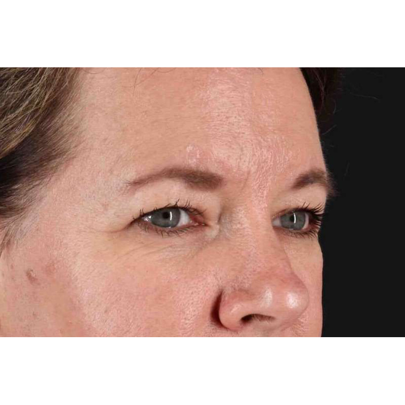 Brow Lift Before & After Patient #1566
