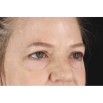 Brow Lift Before & After Patient #1577
