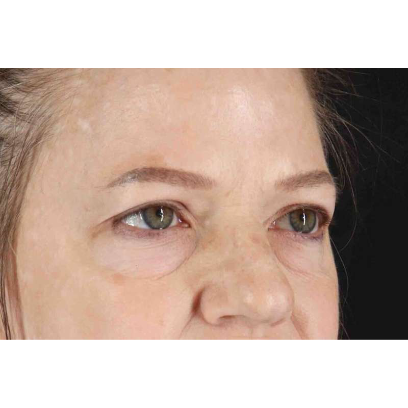 Brow Lift Before & After Patient #1577