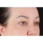 Brow Lift Before & After Patient #1588