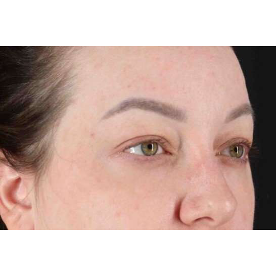 Brow Lift Before & After Patient #1588
