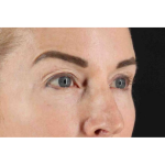 Laser Before & After Patient #2070