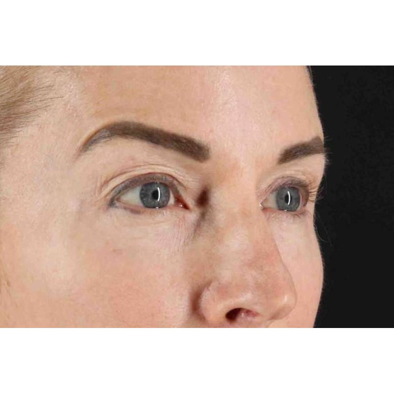 Laser Before & After Patient #2070