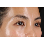Eyelid Surgery Before & After Patient #1935
