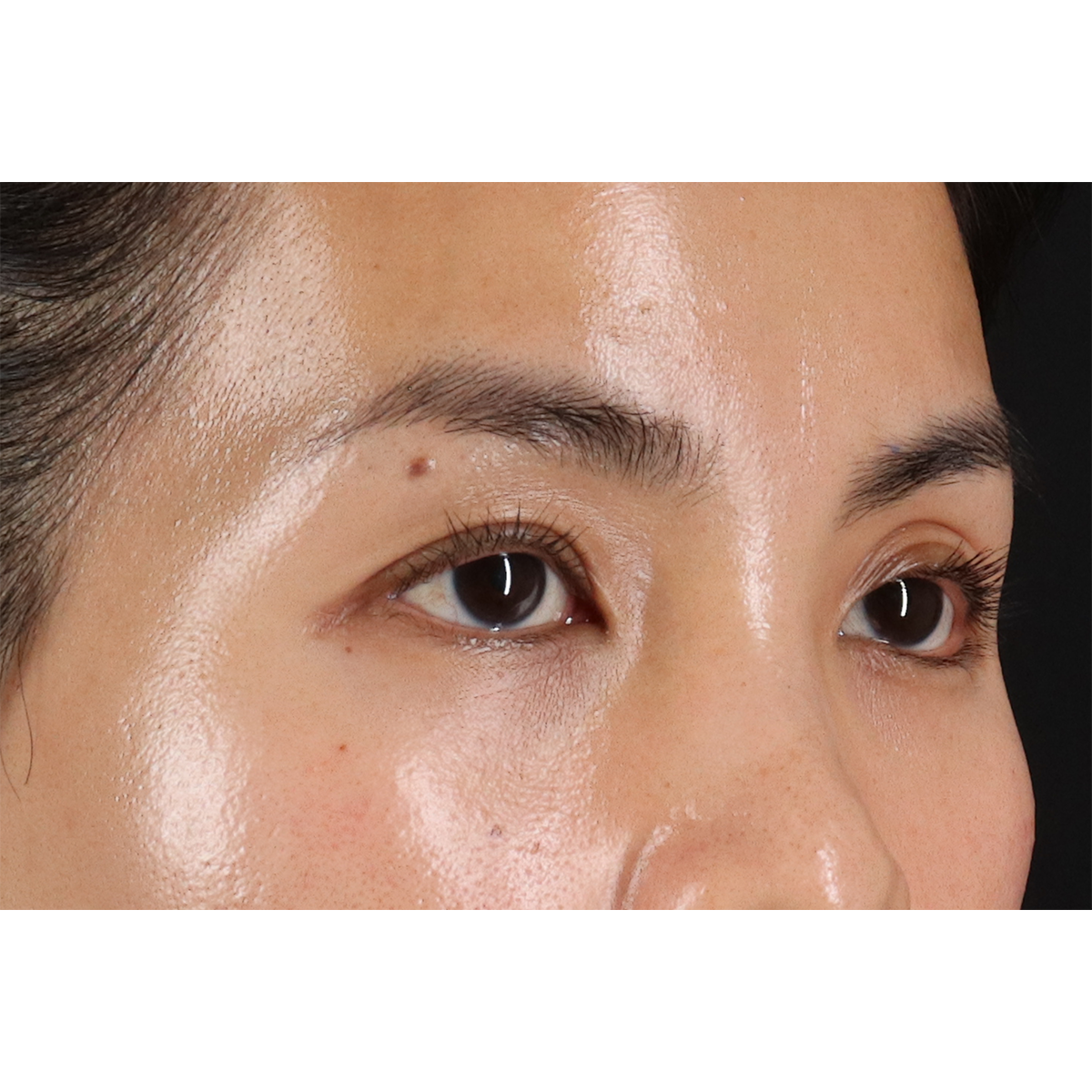 Eyelid Surgery Before & After Patient #1935