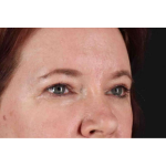 Brow Lift Before & After Patient #1566