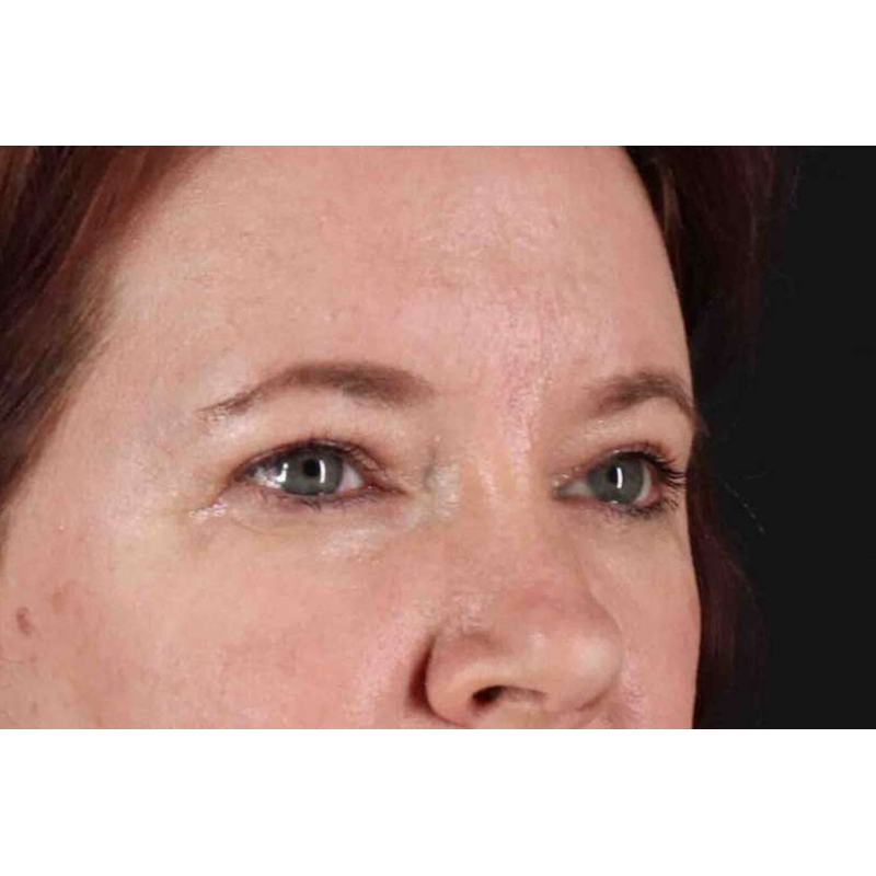 Brow Lift Before & After Patient #1566
