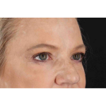 Brow Lift Before & After Patient #1577