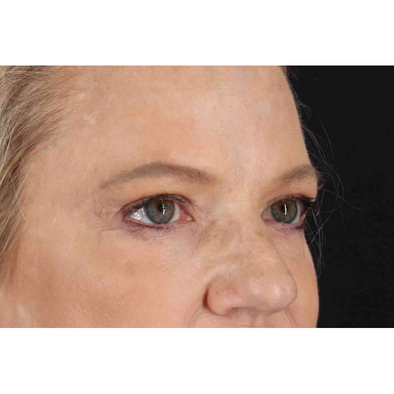 Brow Lift Before & After Patient #1577