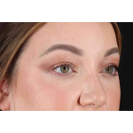 Brow Lift Before & After Patient #1588