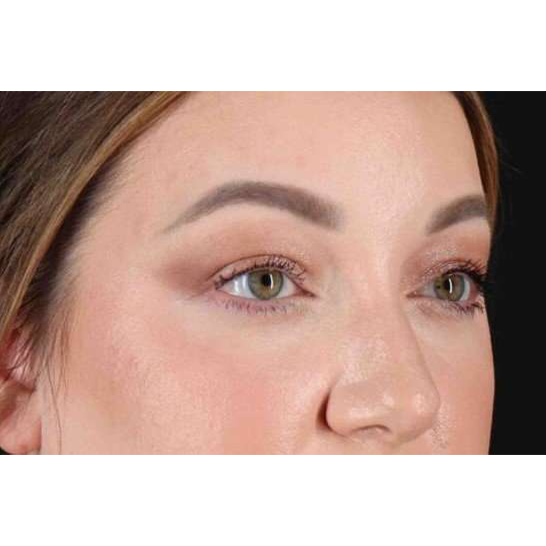 Brow Lift Before & After Patient #1588
