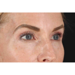 Laser Before & After Patient #2070
