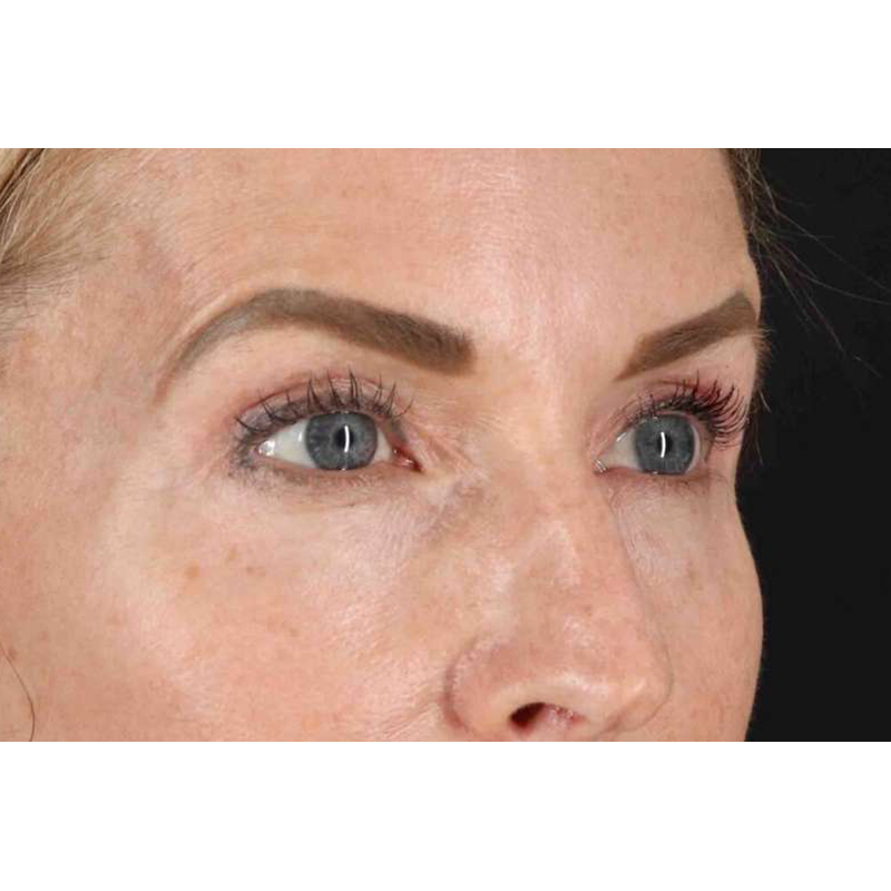 Laser Before & After Patient #2070