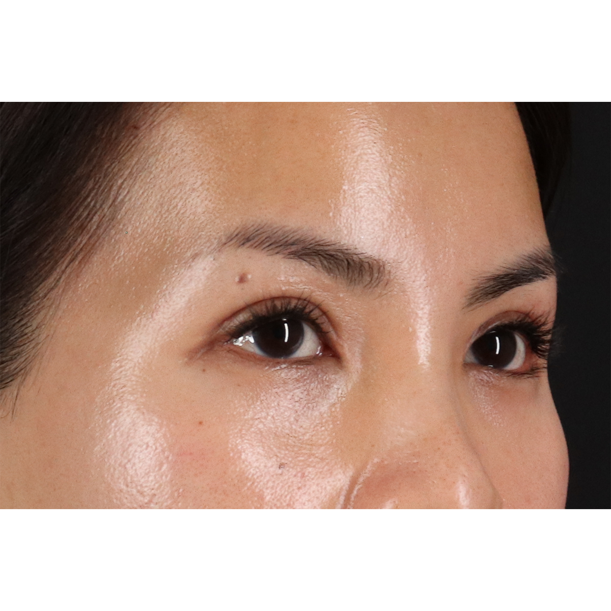 Eyelid Surgery Before & After Patient #1935
