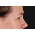 Brow Lift Before & After Patient #1566