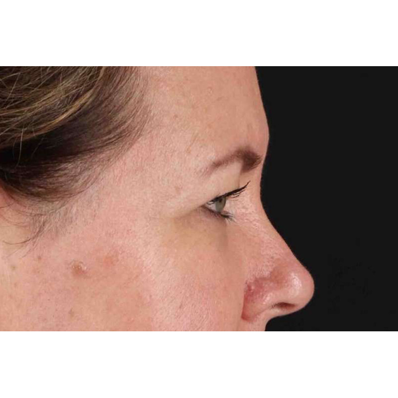 Brow Lift Before & After Patient #1566