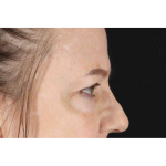 Brow Lift Before & After Patient #1577