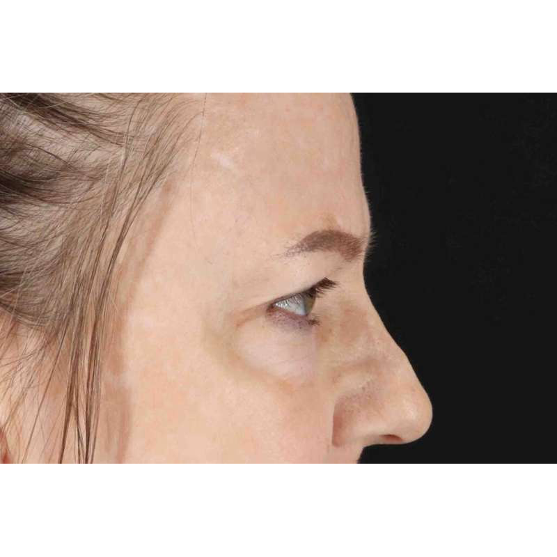 Brow Lift Before & After Patient #1577