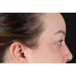 Brow Lift Before & After Patient #1588