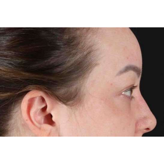 Brow Lift Before & After Patient #1588
