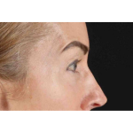 Laser Before & After Patient #2070