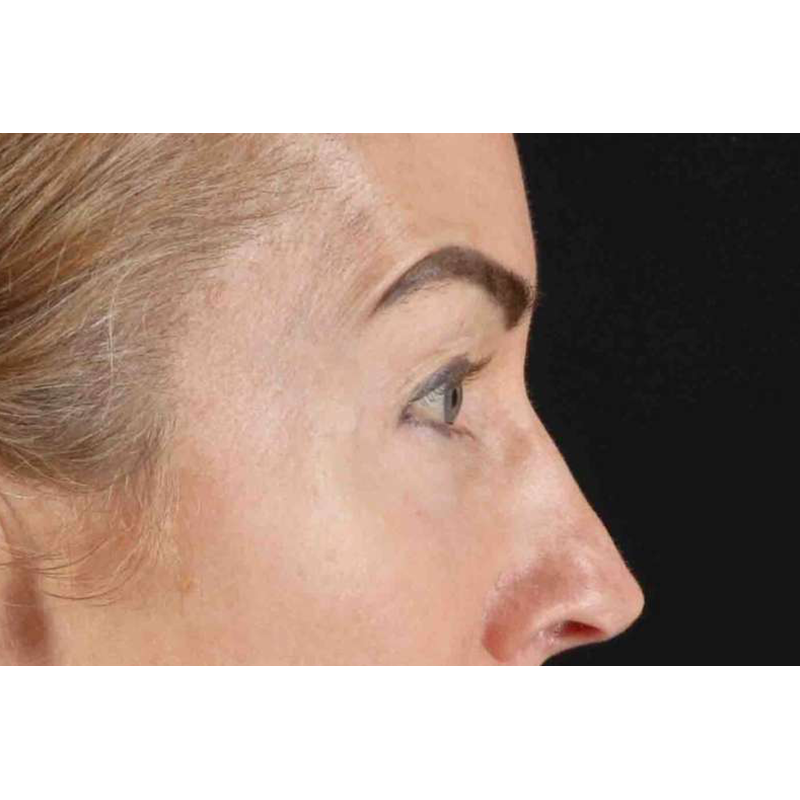 Laser Before & After Patient #2070